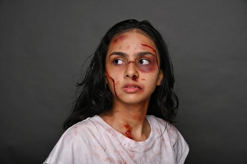 Special-effects makeup simulating cuts and bruising, the model looking off to one side
